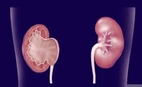 Λαπαροσκοπική Πυελοπλαστική - image